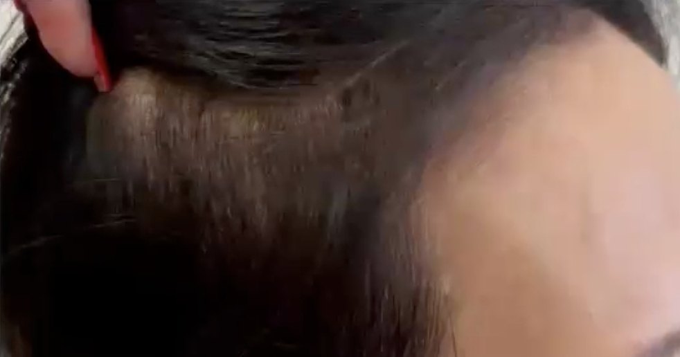Thinning at the temple and hairline, after 2 treatments