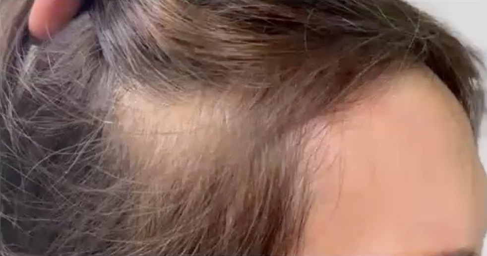 Thinning at the temple and hairline, before treatment