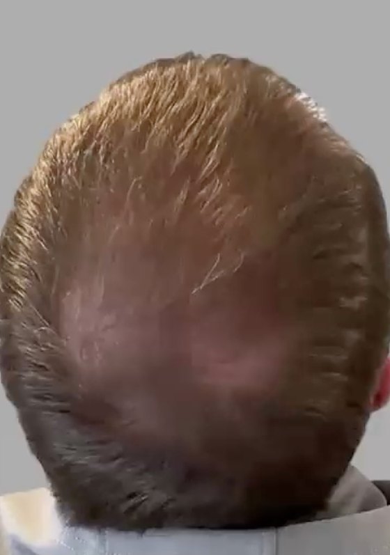 Thinning at the crown, after 5 treatments