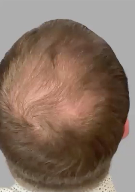 Thinning at the crown, before treatment