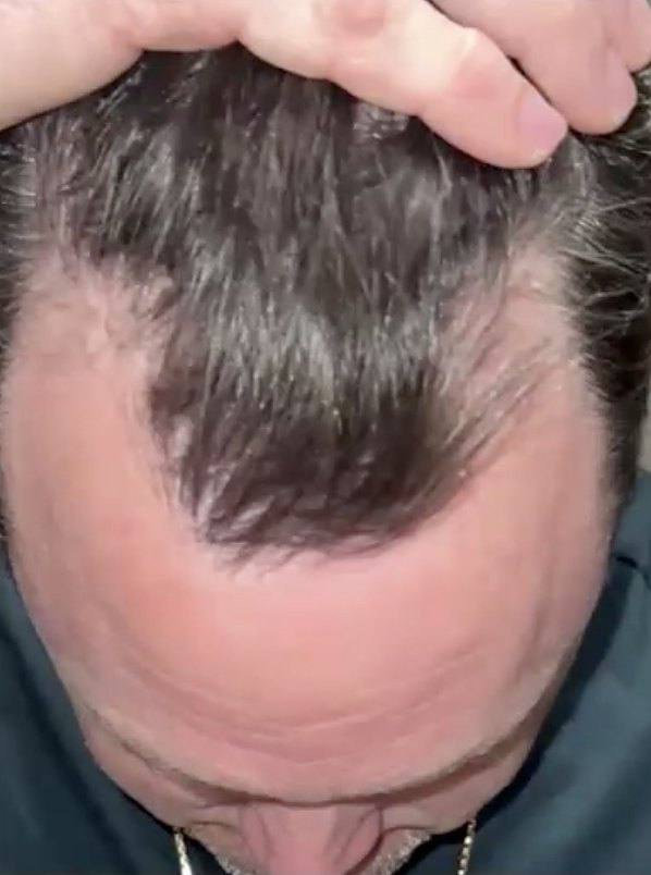 Thinning on the top of the scalp, after 7 treatments