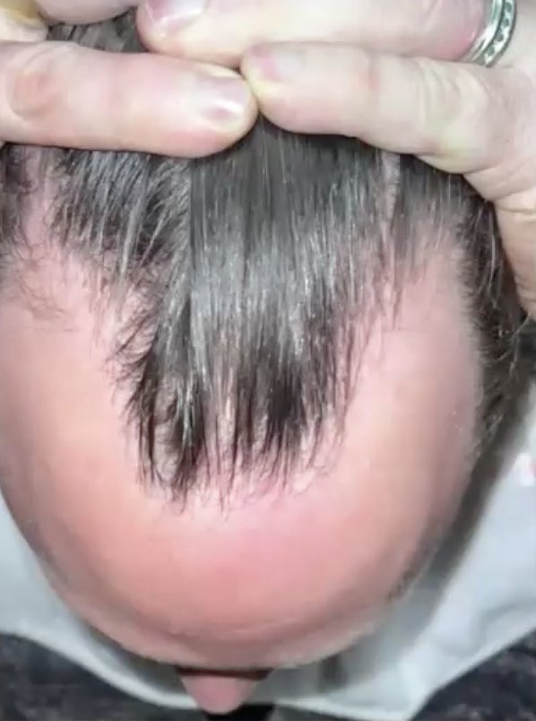 Thinning on the top of the scalp, before treatment
